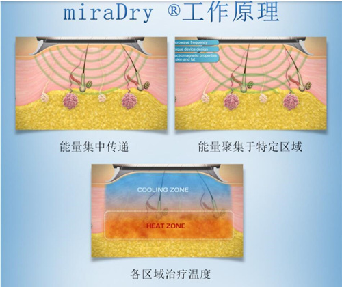 miradry做了不管用_连籽心泡水喝有什么做用_奥淡评的功效与做用